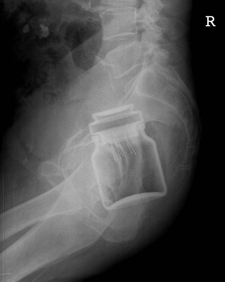Le patient a été admis évidemment pour ce pot de café instantané dans le rectum. On ne sait pas pourquoi des pinces ont été insérées dans la partie intérieure caoutchouteuse du couvercle. ...